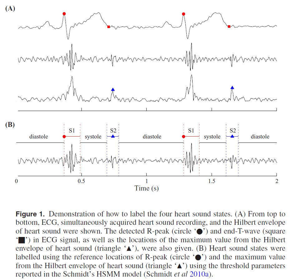 ECG