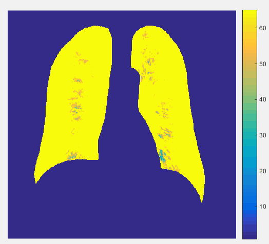 肺部胸片图像掩膜和伪彩色处理matlab