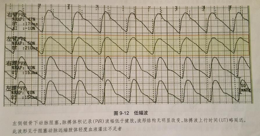 異常脈搏波pvr波形命名和解釋