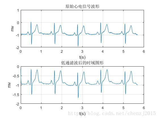 心电图的干扰因素主要有以下三种:工频干扰基线漂移肌电干扰在读取心