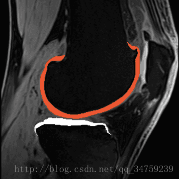膝关节软骨分割，图片来自qure.ai