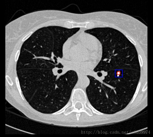 SimpleITK使用深度学习识别肺癌CT DICOM数据集