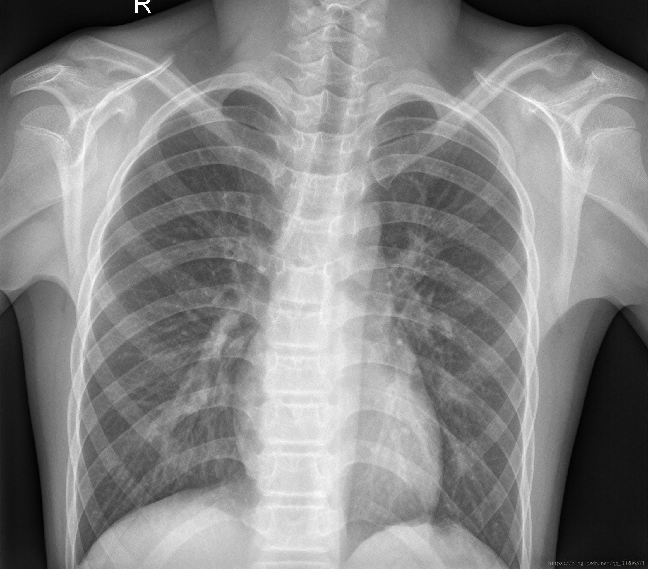 典型双肺粟粒性肺结核一例